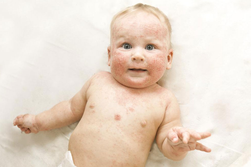 Everything you need to know about atopic dermatitis