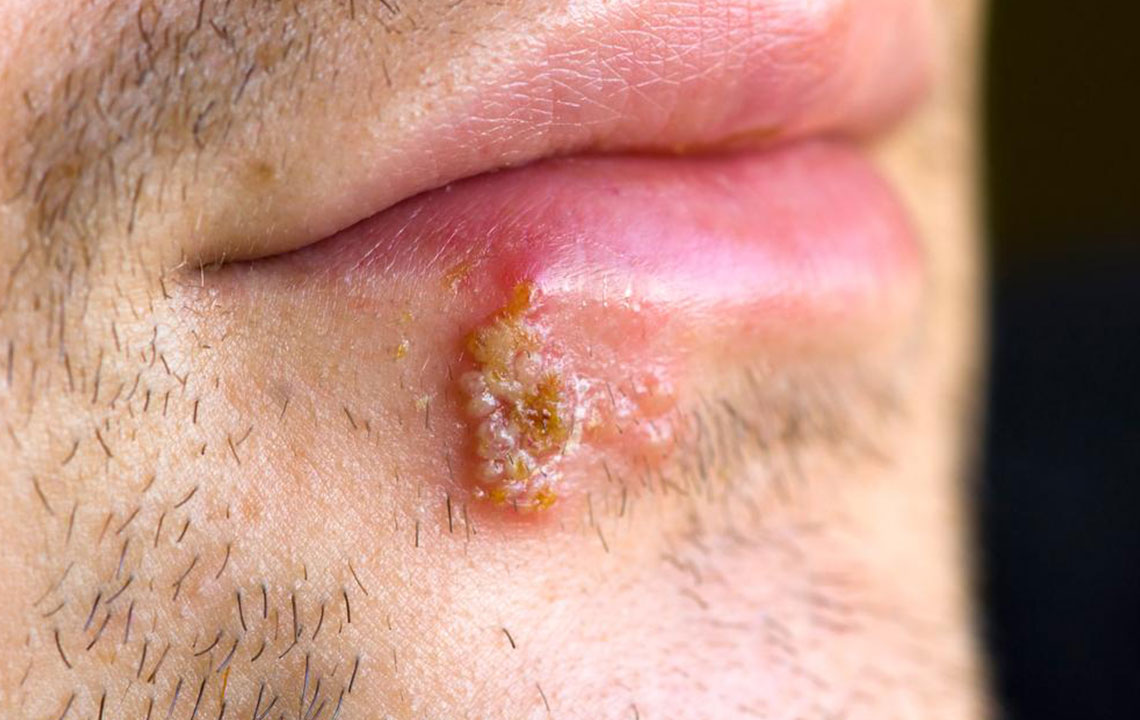 3 quick ways to deal with herpes